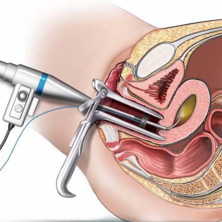 hysteroscopic surgeries in agra